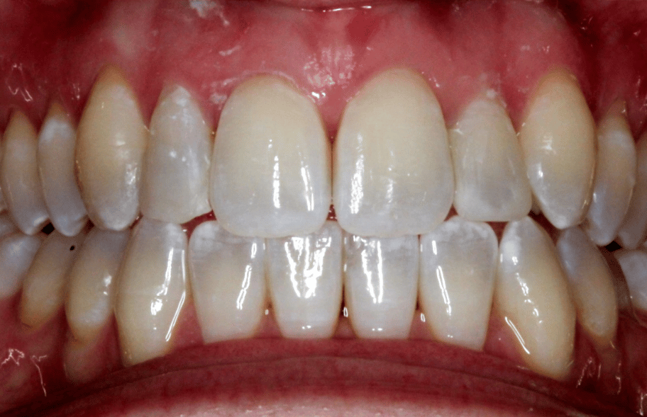 After - Ashbourneroad Dental