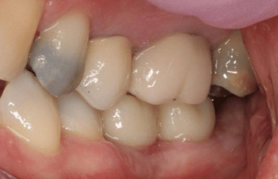 After - Ashbourneroad Dental