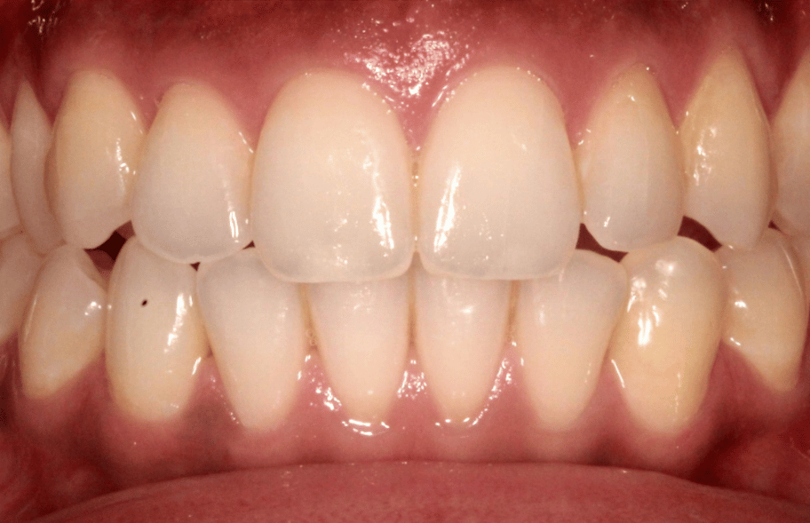 After - Ashbourneroad Dental