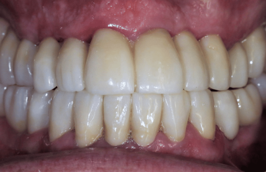 After - Ashbourneroad Dental