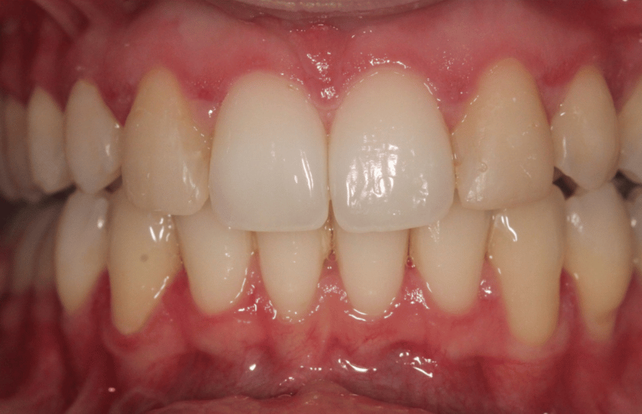 After - Ashbourneroad Dental