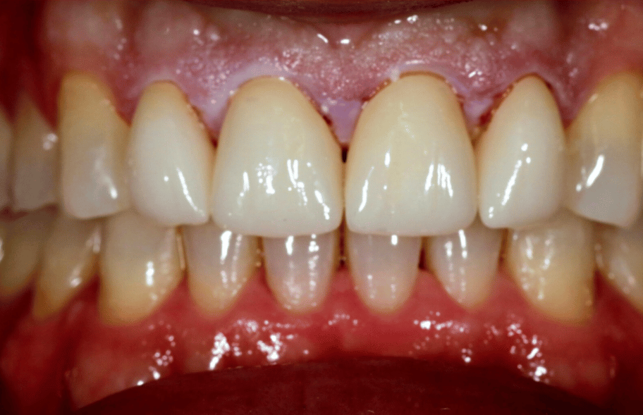 After - Ashbourneroad Dental